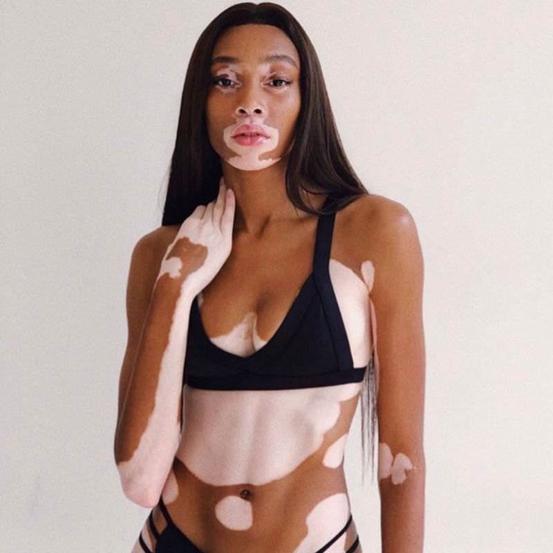 Winnie Harlow - modelo vitiligo